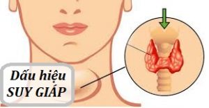 Tổng quan bệnh Suy giáp – Bệnh Viện Đa Khoa Tỉnh Lào Cai