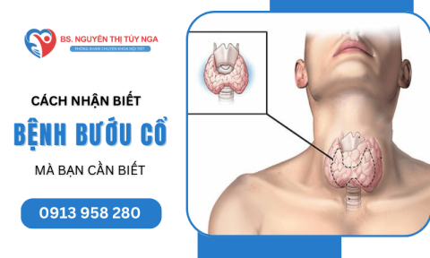 Chia sẻ cách nhận biết bệnh bướu cổ mà bạn cần biết 